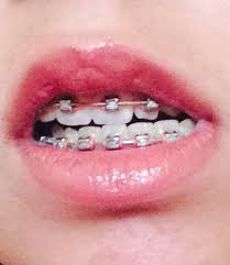 Light Pink Dusty Rose Lips Dusty Rose Lips Pink Braces Dusty Rose