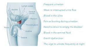 This happens because most people with the condition do not show any symptoms until the cancer has advanced. Prostate Cancer It S More About Living Well With The Disease Than The Risk Of Dying From It Scor