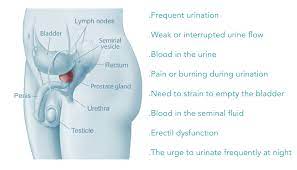 This treatment is an option for curing prostate cancer that has not spread beyond the prostate or has not spread very far. Prostate Cancer It S More About Living Well With The Disease Than The Risk Of Dying From It Scor