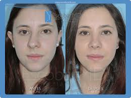 Antes Despues Rinoplastia O Cirugia De Nariz Con Correccion De Laterorrinia O Nariz Desviada En Bog Rhinoplasty Nose Jobs Nose Job Rhinoplasty Before And After