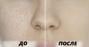 как очистить лицо от черных точек в домашних условиях содой Kak Umenshit Rasshirennye Pory 8 Effektivnyh Receptov Lico Sredstva Protiv Pryshej Chistoe Lico