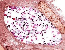Image result for Chlamydia Trachomatis