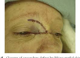 Image result for Eyelid Closure Defect
