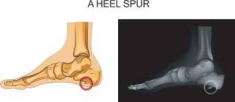 Maybe you would like to learn more about one of these? Bone Spur Treatment Heel Spur Treatment Dr Scheone