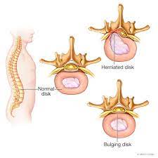 Radiculopathy Mayo Clinic Orthopedics Sports Medicine