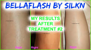 The elos plus system was designed for effective hair removal, while providing unsurpassed safety. Bellaflash Hair Removal System By Silk N Exclusive At Costco My Results After 2 Treatments Youtube