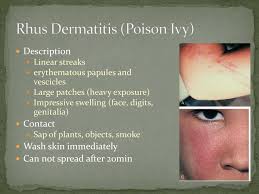Image result for Rhus Dermatitis