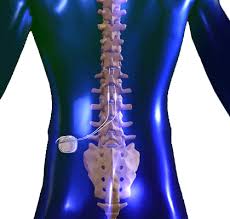 Post Laminectomy Syndrome Failed Back Or Neck Syndrome