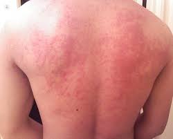 Image result for dermatitis contacta allergica