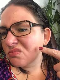 Hello!! I'm a nurse and struggle with rosacea (quite bad). My face is  constantly red and people make it worse when making comments like “are you  sunburnt or have you got a