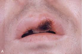 Image result for Primary Syphilis