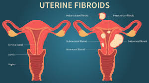 Women's health may earn commission from the. The Link Between Uterine Fibroids And Heavy Menstrual Bleeding Everyday Health