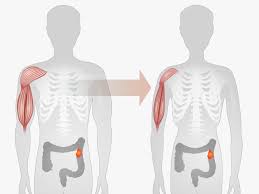 Image result for Cachexia in Cancer