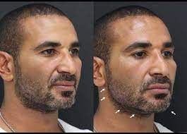 ولد أحمد سعد علي سيد قناوي في 20 أغسطس 1981 في القاهرة ، وسبق له من الزواج من الممثلة المصرية ريم البارودي في نفس العام قبل أن يعلنا انفصالهم. ØµÙˆØ± ØªÙƒØ´Ù Ø¥Ø¬Ø±Ø§Ø¡ Ø£Ø­Ù…Ø¯ Ø³Ø¹Ø¯ Ø¹Ù…Ù„ÙŠØ§Øª ØªØ¬Ù…ÙŠÙ„ Ø­Ø´Ùˆ Ù‡Ø§ÙŠ Ø¬ÙŠ Ø¨Ø±Ø§ÙŠÙ… ÙÙŠÙ„Ø± Ù„ØªØ¹Ø²ÙŠØ² Ù…ÙŠØ²Ø§Øª Ø§Ù„Ø°ÙƒÙˆØ± Ø§Ù„Ù‚ÙˆÙŠØ© Ø§Ù„Ù…ØµØ±ÙŠ Ø§Ù„ÙŠÙˆÙ…