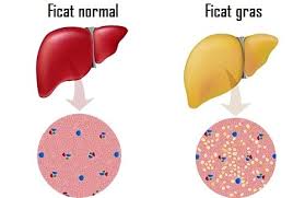Ficat gras sau steatoza hepatica, cauze si simptome, tratament naturist cu produse calivita, regim alimentar, mod de preventie al bolii. Tratament Naturist Èi DietÄ Pentru Ficat Gras SteatozÄ HepaticÄ Lataifas