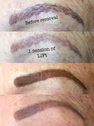 Our state of the art quanta q plus laser system (the best triple laser system available) and trained tattoo removal technicians will restore your look without crushing your budget! Saline Tattoo Removal Services In Colorado Pmac