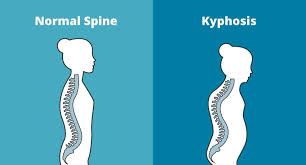 We did not find results for: Kyphosis Curvature Of The Upper Spine Once Called A Dowager Hump
