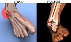 We did not find results for: Is Sprained Ankle A Serious Injury Quora
