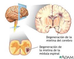 Multiple sclerosis (ms) is a condition that can affect the brain and spinal cord, causing a wide range of potential symptoms, including problems with vision, arm or leg movement, sensation or balance. Esclerosis Multiple Diagnostico Serie Indicaciones Medlineplus Enciclopedia Medica
