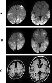 The neuroimaging modality of choice for hse diagnosis is magnetic resonance imaging (mri). Parechovirus A3 Encephalitis Presenting With Focal Seizure Mimicking Herpes Simplex Virus Infection Journal Of Infection And Chemotherapy