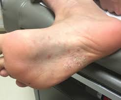 Image result for Secondary Syphilis