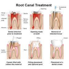 Emergency Dentistry Apexdental Root Canal Treatment Root Canal Dental