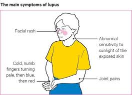 Lupus symptoms differ from person to person. Lupus Sle Causes Symptoms Treatment Versus Arthritis