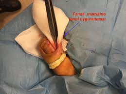 Tirnak Batmasi Tedavisi Ortopedi Ve Travmatoloji Uzmani Opr Dr Halil Buldu