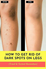 Home Remedies For Dark Spots On Legs Knees And Thighs In 2020 Dark Spots On Legs Dark Spots On Skin Spots On Legs