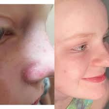 Marula oil not suitable for oily skin