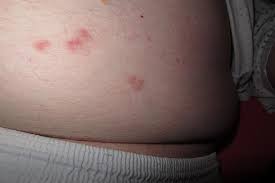 Coxsackieviruses are divided into group a and group b viruses based on early observations of their pathogenicity in neonatal mice. Rote Flecken Am Bauch Welche Erkrankung Steckt Dahinter