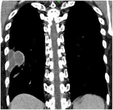Image result for Pleural Tuberculosis