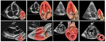 Sie führt zu einer abnahme der leistungsfähigkeit des herzens (herzinsuffizienz) und zu herzrhythmusstörungen.das klinische bild entspricht dem einer dilatativen kardiomyopathie mit brustschmerzen, luftnot und palpitationen (herzklopfen, herzunruhe) die erkrankung gilt als unterdiagnostiziert. Echokardiographie Mit Ultraschall Ins Herz Blicken Kardiologie Osypka Herzzentrum Munchen