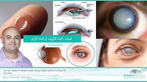 ساد العين كيفية إجراء العملية عيادات السالم لطب و جراحة العين أ د خليل السالم