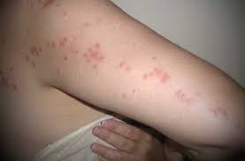 Flea bites often appear as groups of small scabs. Bed Bug Bites Pictures Patterns Symptoms And Remedy