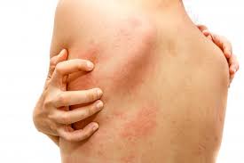 5 Common Triggers Of Sudden Onset Hives Air Care Asthma Allergy And Immunology