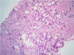 It involves removing a sample of tissue, which is examined under a microscope by a specialist doctor called a pathologist. Malignant Pleural Mesothelioma Presenting With Cardiac Tamponade A Rare Case Report And Review Of The Literature