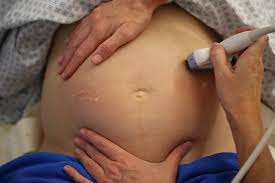 Image result for External Cephalic Version