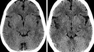 Serology for hsv showed positive hsv (1+2) igg and negative igm. Herpes Encephalitis The Neurosurgical Atlas By Aaron Cohen Gadol M D