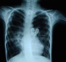 Broken Heart Congenital Heart Defect Heart Defect Congenital Heart