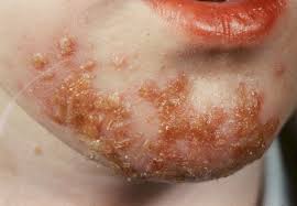 Image result for Impetigo