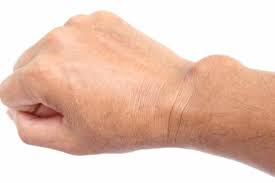 Ganglion An Fingern Hand Knie Oder Fuss Gesundheit De