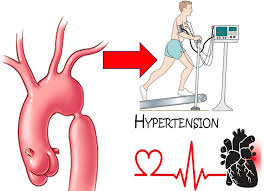 Компрессор nlx10kk2 comp.r600a 220v danfoss nlx10kk2. Mild Coarctation Of Aorta Is An Independent Risk Factor For Exercise Induced Hypertension Hypertension