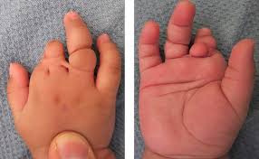 Several techniques are used to the volume of the implant was administered gradually, until the deformity was corrected. Congenital Hand Differences A Review Iranian Journal Of Pediatrics Full Text