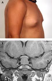 Image result for Precocious Puberty