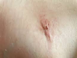 Emf kann auch einen effekt auf herzschrittmacher, bildschirmen und. Narben 2 Wochen Nach Laparoskopischer Blinddarmop Normal Gesundheit Und Medizin Haut Blinddarm