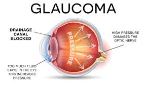 This damage is often caused by an abnormally high pressure in your eye. Glaucoma Types Causes Symptoms And Treatments