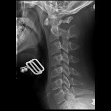 We did not find results for: Jefferson Fracture Radiology Case Radiopaedia Org