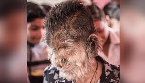 The term human werewolf syndrome refers to the condition wherein a werewolf, while in wolf form, maintains its human consciousness. A Strange Child Born With Werewolf Syndrome Disease Virily