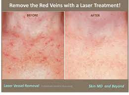 We did not find results for: Broken Capillaries On Neck And Chest